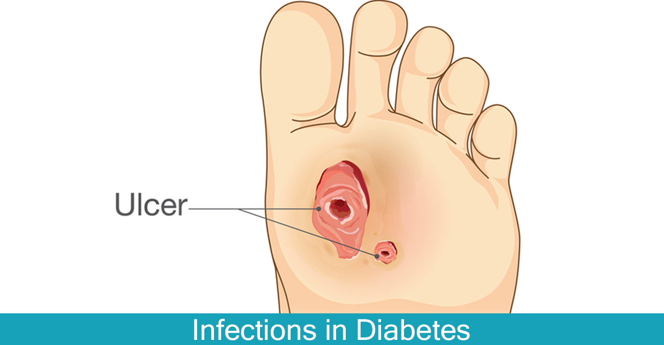 Infections in Diabetes