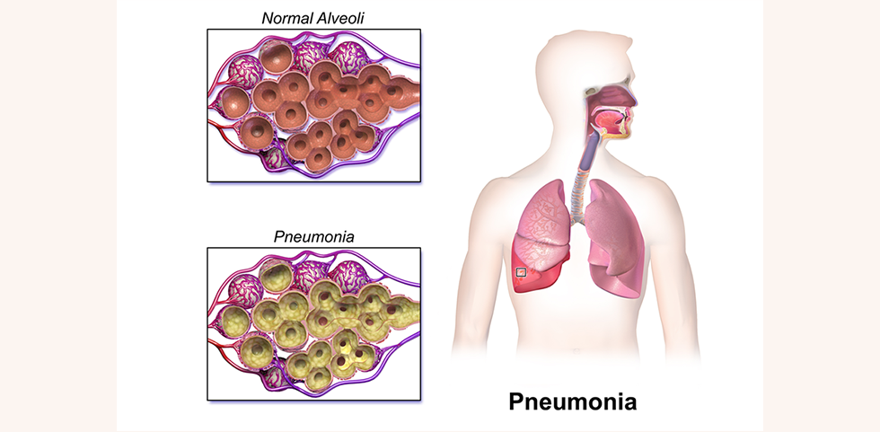 lung infectionpneumonia treatment in borivali mumbai