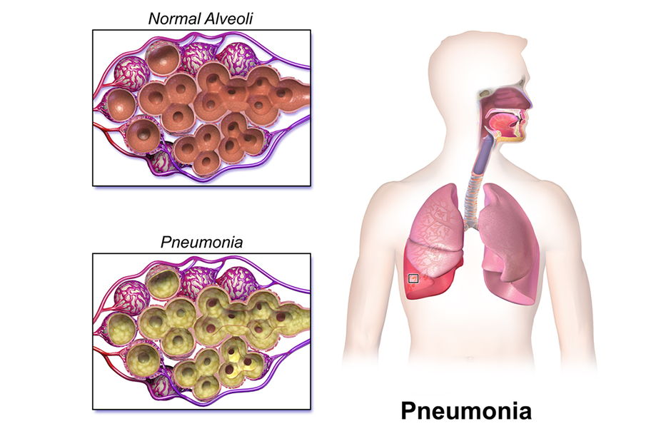 Organ specific infections