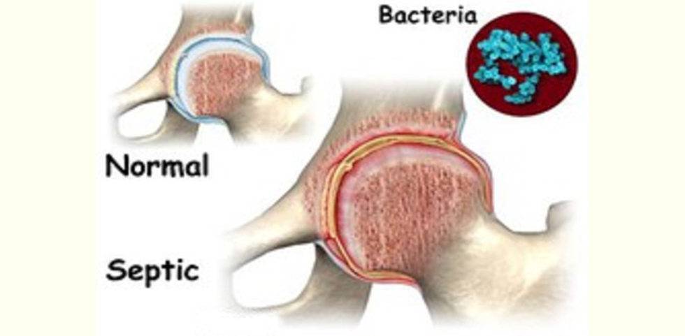 Bone and joint infections 