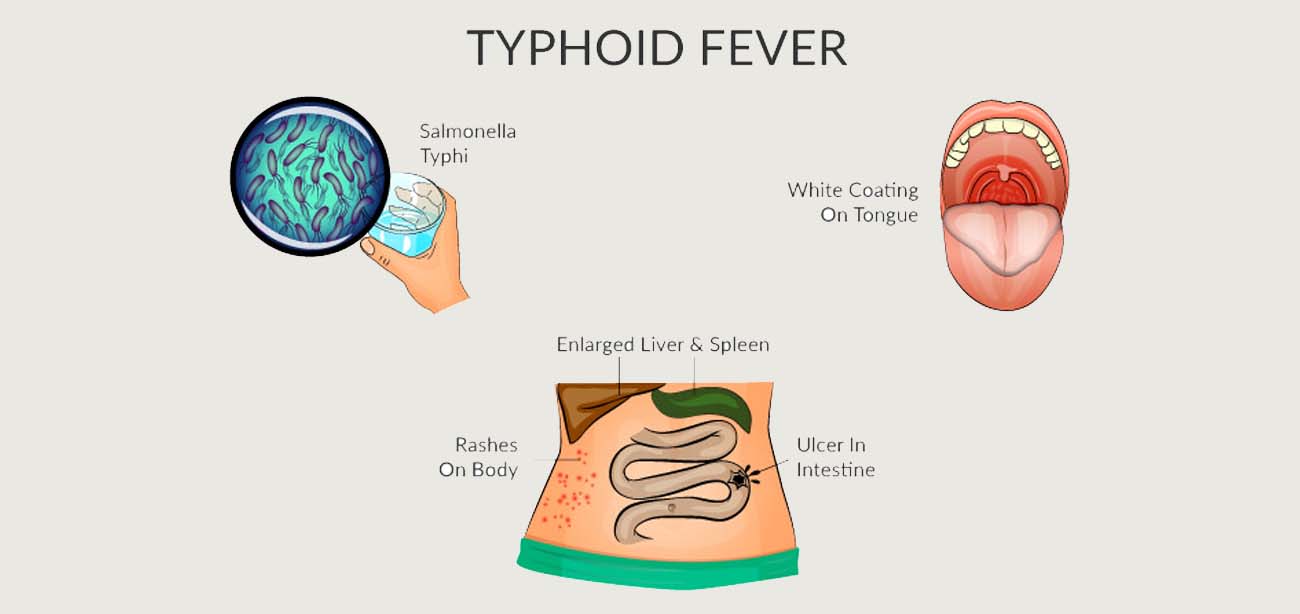 acute fever conditions treatment in borivali mumbai